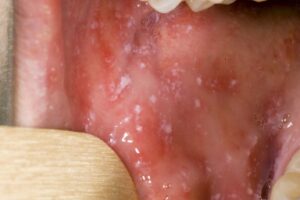 measles spots in mouth