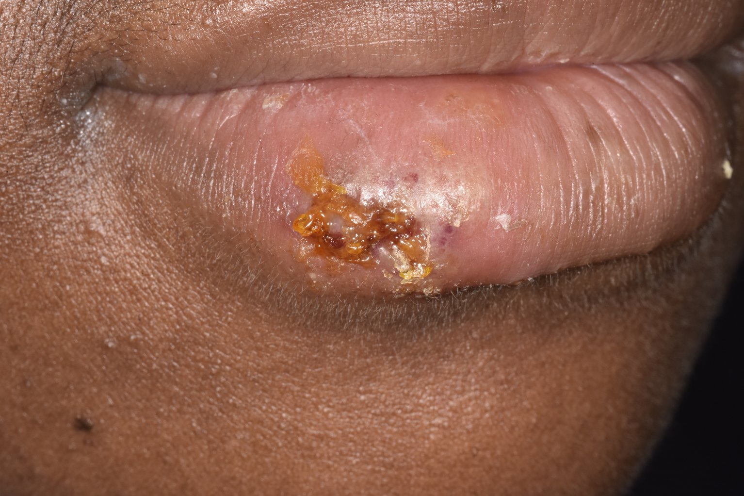 Image of a cold sore blister